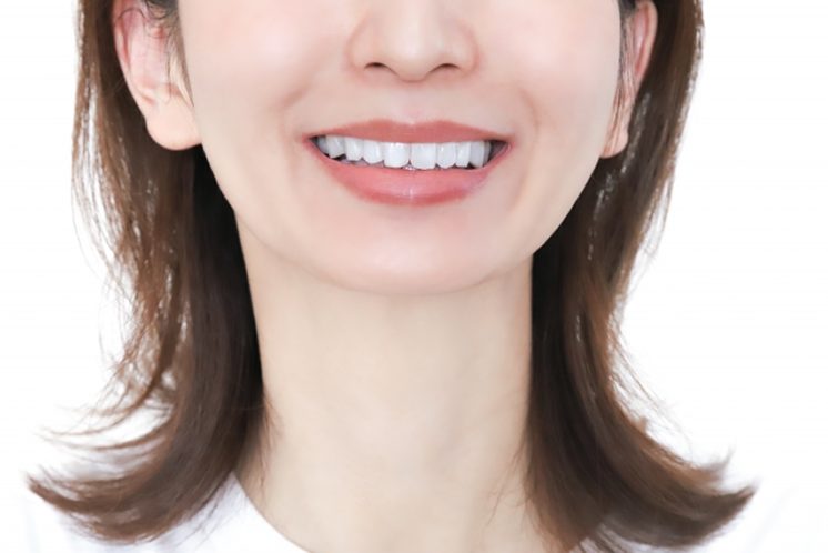 ラミネートべニアとは